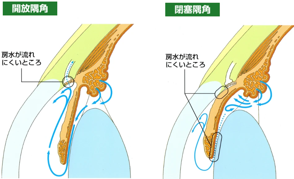 開放隅角と閉塞隅角の比較図。開放隅角では隅角は開いているが線維柱帯の部分で房水が流れにくくなる。閉塞隅角では虹彩が前に押されて隅角がふさがり、房水が流れにくくなる。