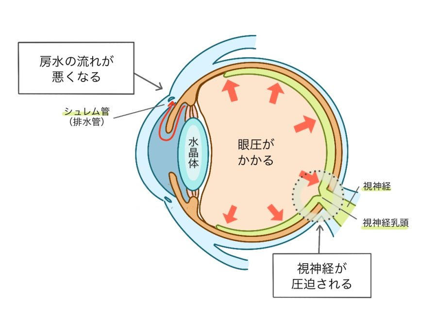 眼の断面図。房水の流れが悪くなりシュレム管（排水管）から排出されにくくなると、眼圧が上がって視神経乳頭の部分で視神経が圧迫される様子を示した図。