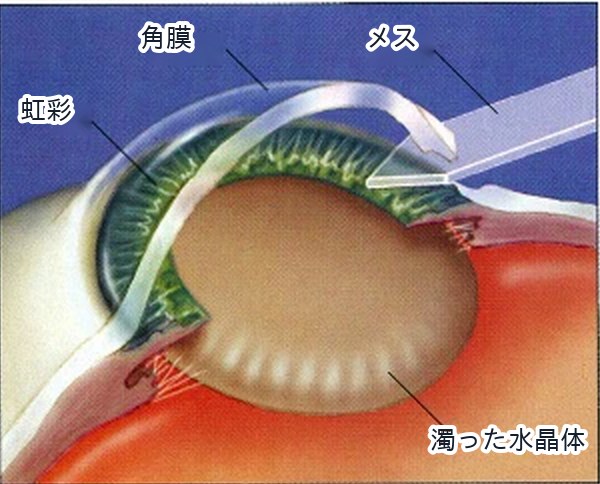 白内障手術の流れ 1：切開。角膜の縁を小さく切開します。