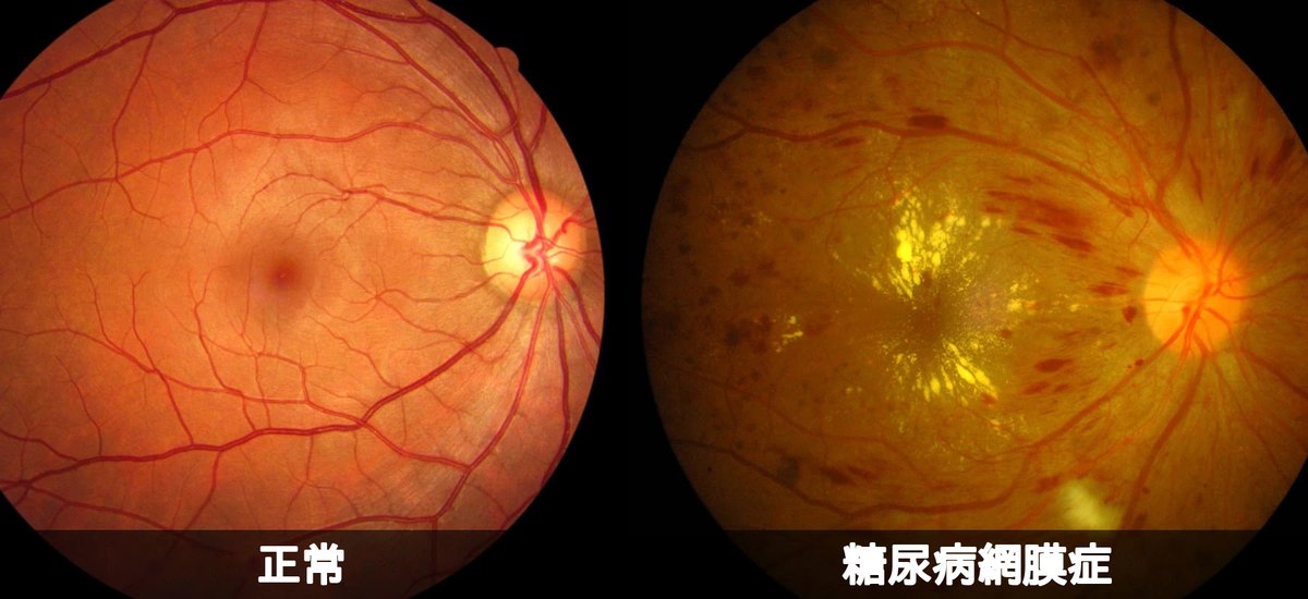 正常な眼底と糖尿病網膜症の眼底の写真の比較。糖尿病網膜症では、網膜に出血や白っぽい沈着物（硬性白斑）が多数みられる。
