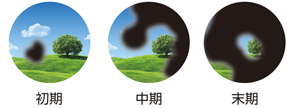 緑内障の進行による視野の変化のイメージ。初期は一部に見えない部分が現れ、中期で広がり、末期には中心のわずかな範囲しか見えなくなる。