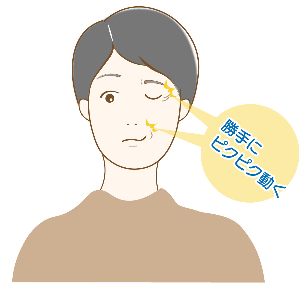 片側顔面けいれんのイラスト。顔の片側の目のまわりや口元が勝手にピクピク動く。血管による顔面神経の圧迫により、多くは片側に起こる。