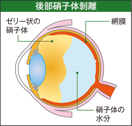 後部硝子体剥離：ゼリー状の硝子体が縮んで網膜から離れる。