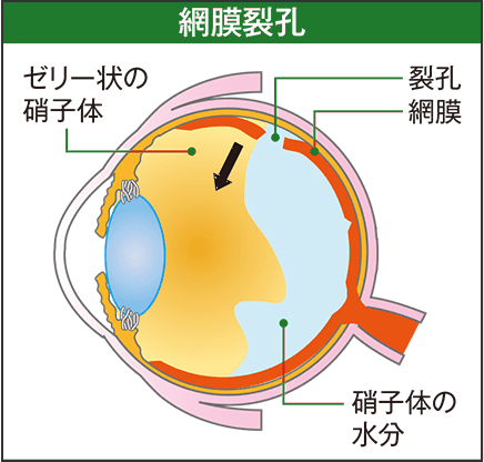 網膜裂孔：硝子体に網膜が引っ張られて、網膜に穴（裂孔）があく。