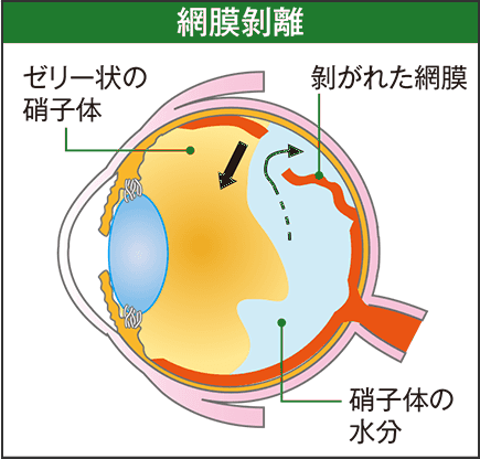 網膜剥離：裂孔から硝子体の水分が入り込み、網膜がはがれる。